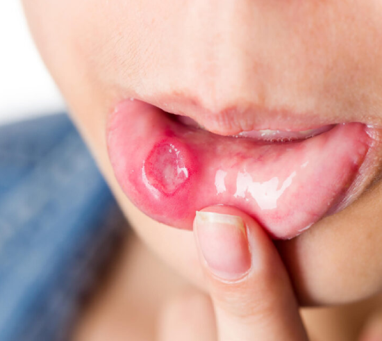 Oral cancer treatment in Jaipur