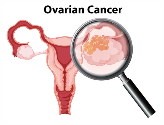 Ovarian cancer treatment in Jaipur