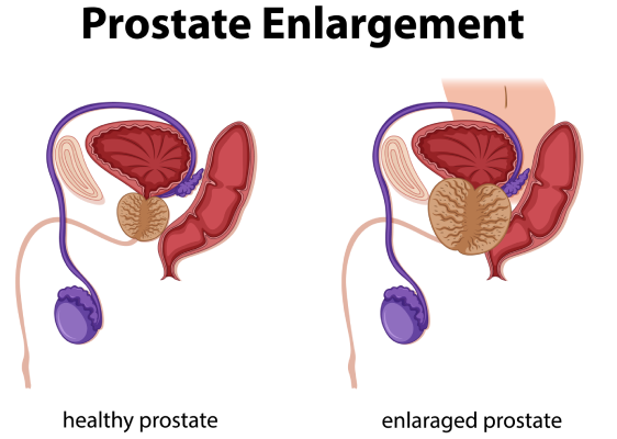 Prostate cancer treatment in Jaipur