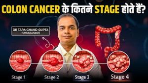 कोलन कैंसर के 4 स्टेज – लक्षण, इलाज और ठीक होने की संभावना | Stage 0 से Stage 4 तक पूरी जानकारी
